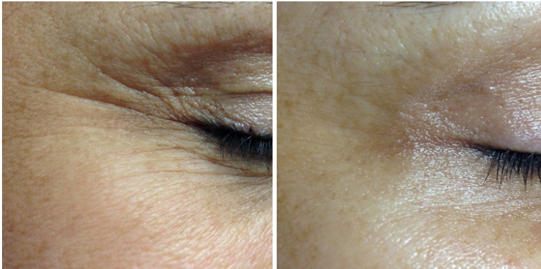 Resultado facial antes y después