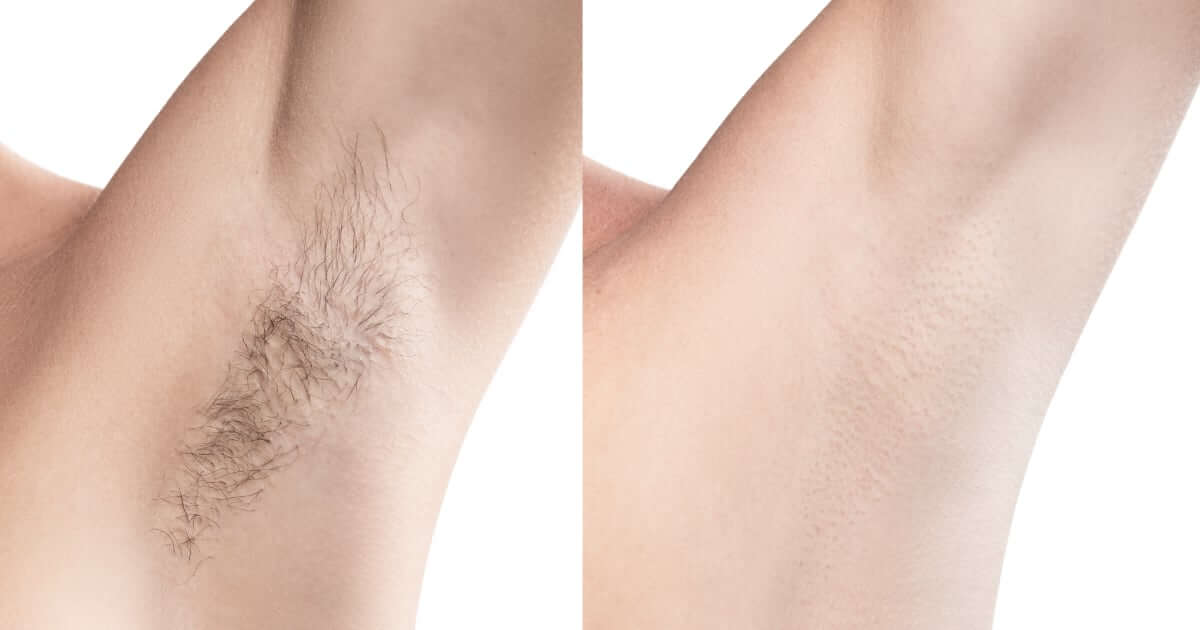 Resultado reducción de vello antes y después